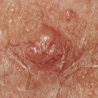 Hautkrankheiten: Akne, Ekzem und Psoriasis