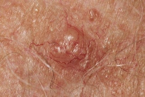 Hautkrankheiten: Akne, Ekzem und Psoriasis